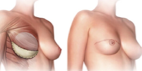 ¿Qué debes saber antes de la mastectomía?