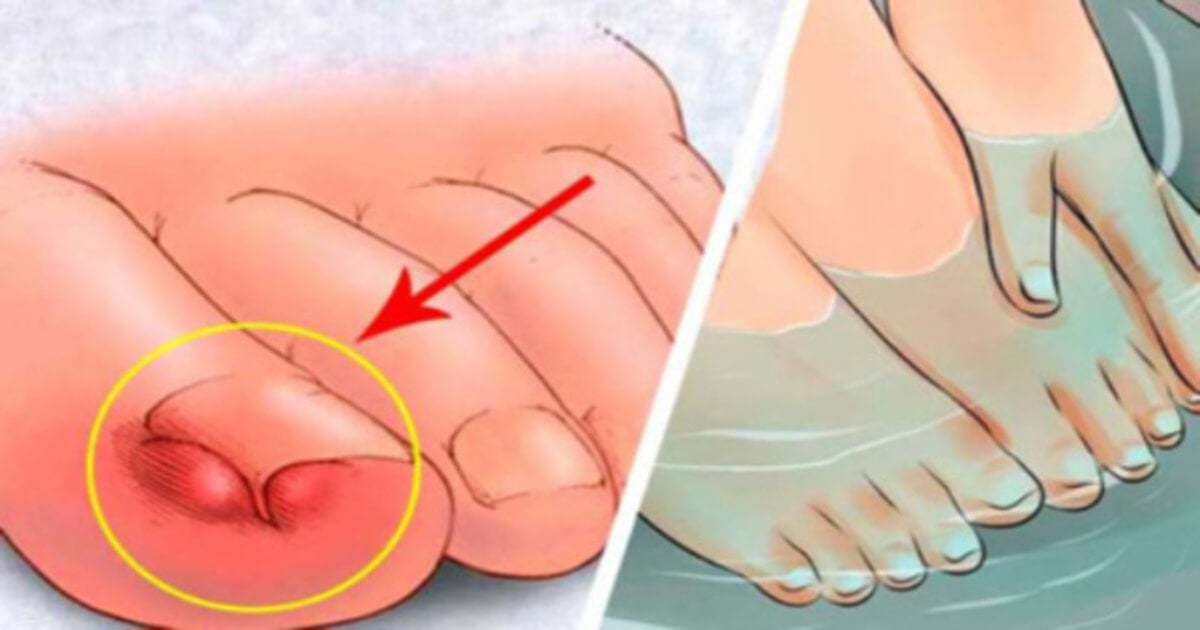 Uñas gruesas: cómo cortarlas y tratarlas adecuadamente en los pies