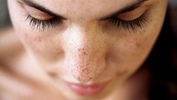 Estas 6 soluciones naturales te ayudarán a remover las manchas y los puntos negros