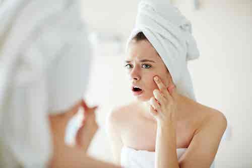 5 aceites esenciales para combatir el acné