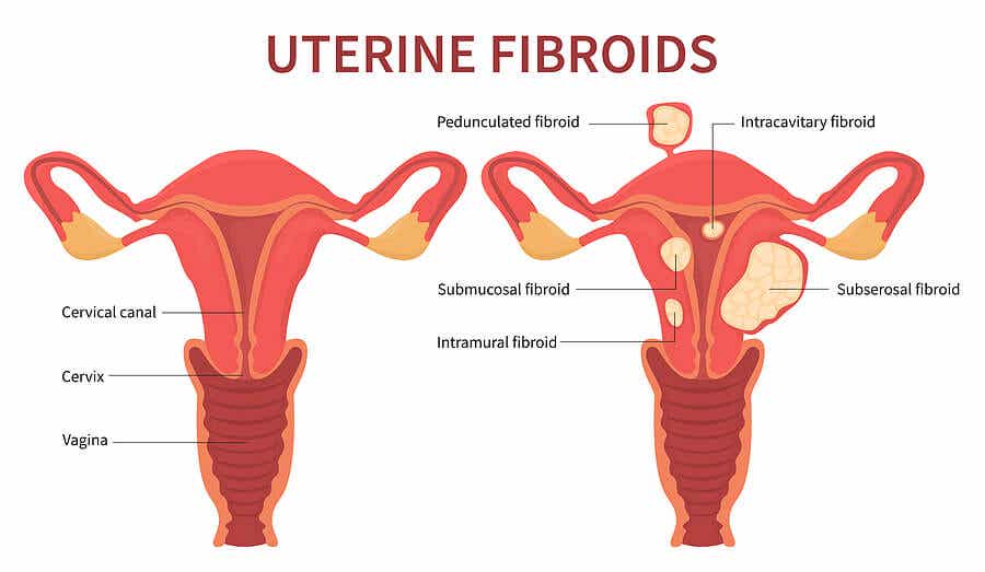 Miomas uterinos.