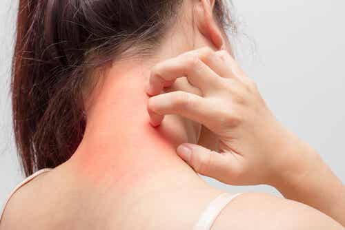 Cómo curar naturalmente los eczemas que causan picor