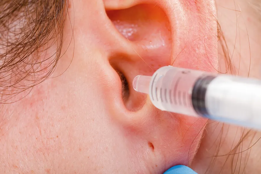 Limpieza de oídos para sacar cerumen.
