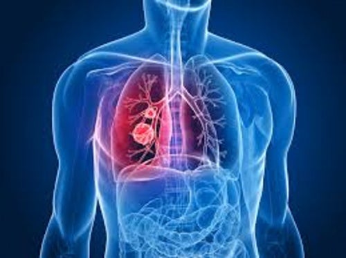 Neumonía o pulmonía