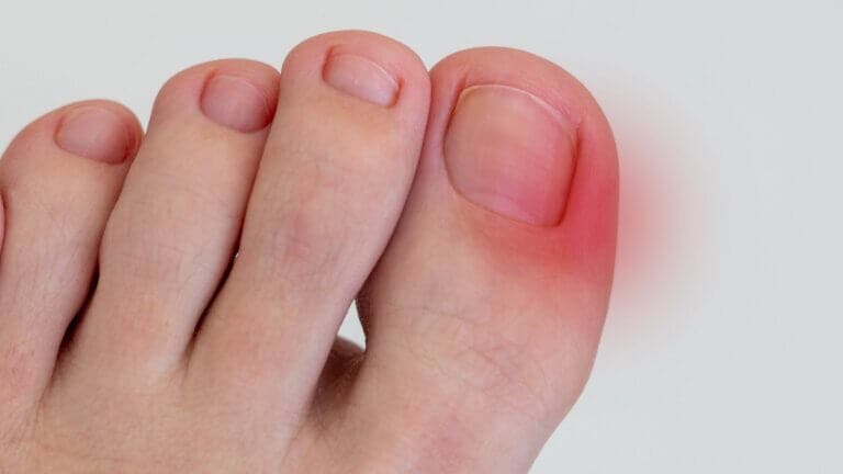 10 remedios caseros para aliviar las uñas encarnadas
