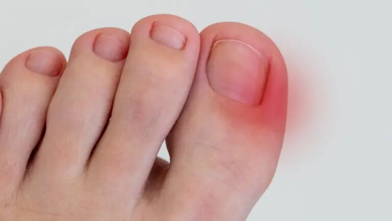 10 remedios caseros para aliviar las uñas encarnadas