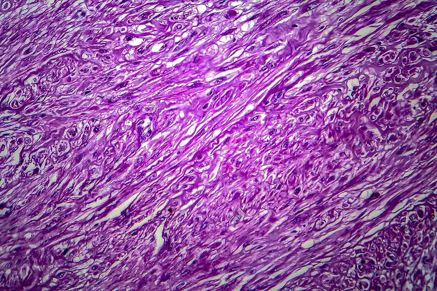 Vista microscópica de miomas uterinos