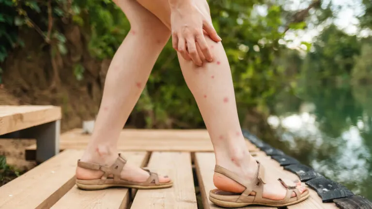 11 remedios caseros para aliviar las picaduras de las pulgas