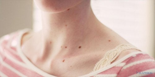 Skin spots are on of the important symptoms for the elderly