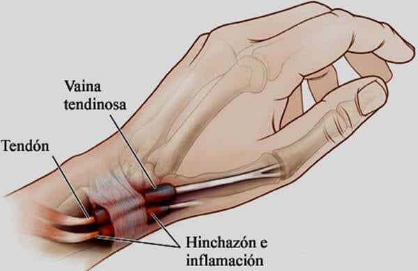 Tenosinovitis: la inflamación en manos o pies que debes conocer