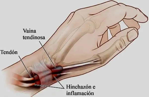 Tenosinovitis: la inflamación en manos o pies que debes conocer