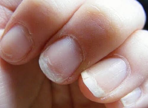 Uñas débiles y quebradizas.