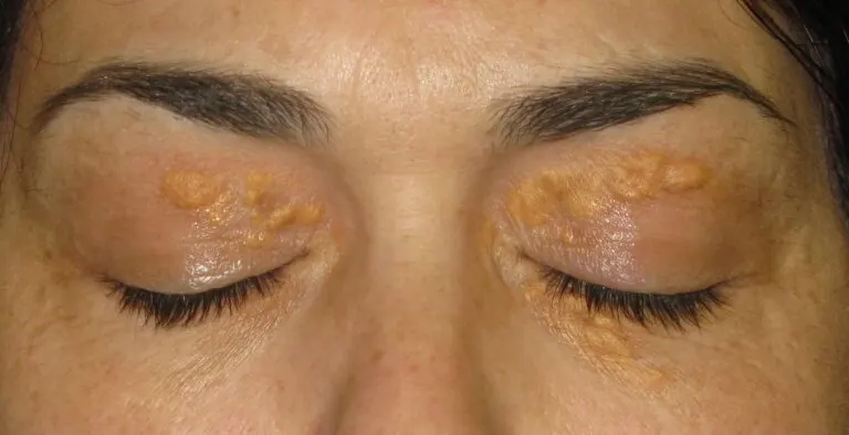 Xantelasmas: esas manchas blancas alrededor de los ojos