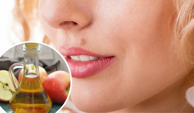 ¿Cómo eliminar lunares de forma natural?
