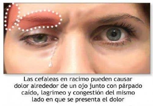 cefalea en racimos