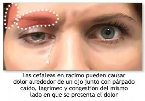 cefalea en racimos