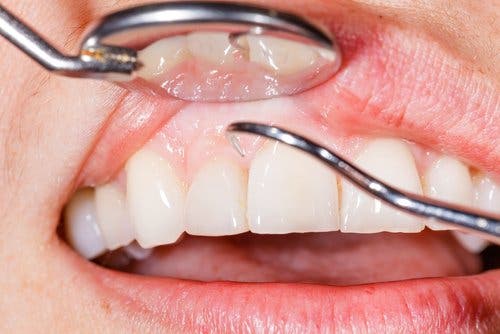 Inflamación de encías y garganta puede ser una señal de que tu hígado está sobrecargado