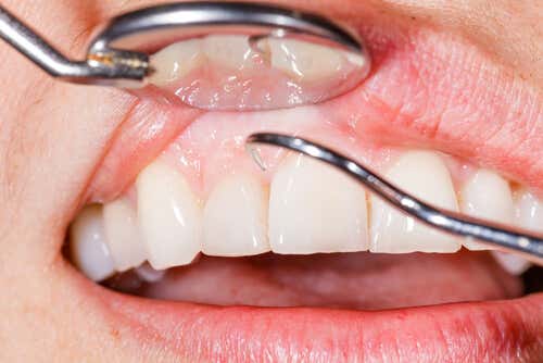 14 razones por las que te sangran las encías al cepillarte los dientes