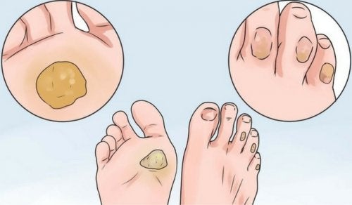 10 remedios para decirle adiós a los callos y ampollas