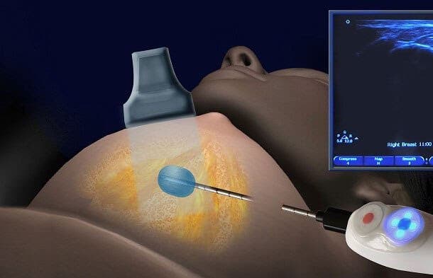Crioablación una nueva opción para el tratamiento del cáncer de mama