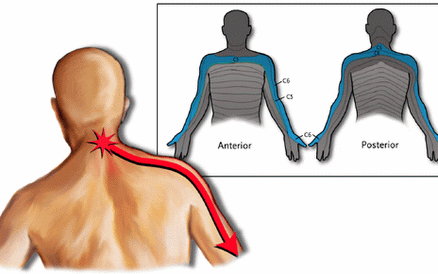 cervicobraquialgia-ese-dolor-que-va-del-cuello-hasta-el-brazo