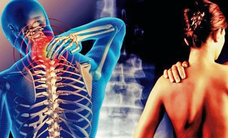 Cervicobraquialgia: ese dolor que va del cuello hasta el brazo