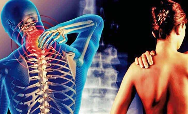 Cervicobraquialgia: ese dolor que va del cuello hasta el brazo