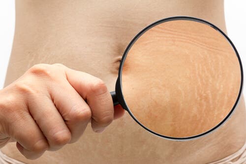 6 trucos para mejorar el aspecto de tus estrías