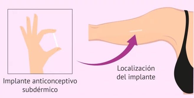 Todo Lo Que Debes Saber Sobre Los Implantes Anticonceptivos Subdérmicos — Mejor Con Salud