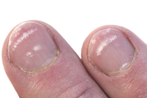 ¿Por qué aparecen marcas blancas en las uñas?