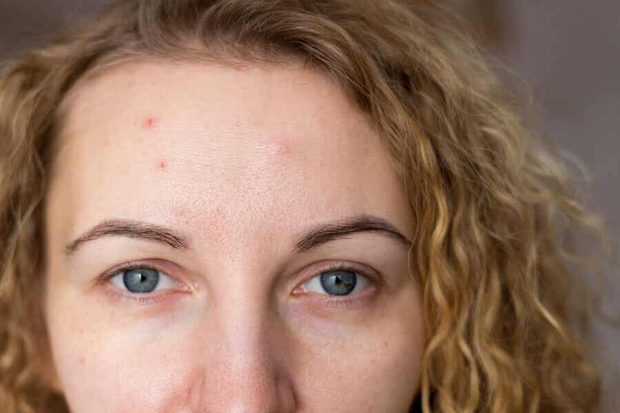 Mujer con brote de acné por ansiedad.