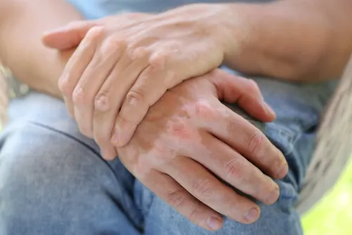 ¿Se puede curar el vitiligo con remedios caseros?