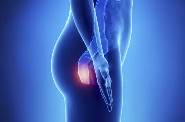 5 síntomas del cáncer de ano, la enfermedad silenciosa