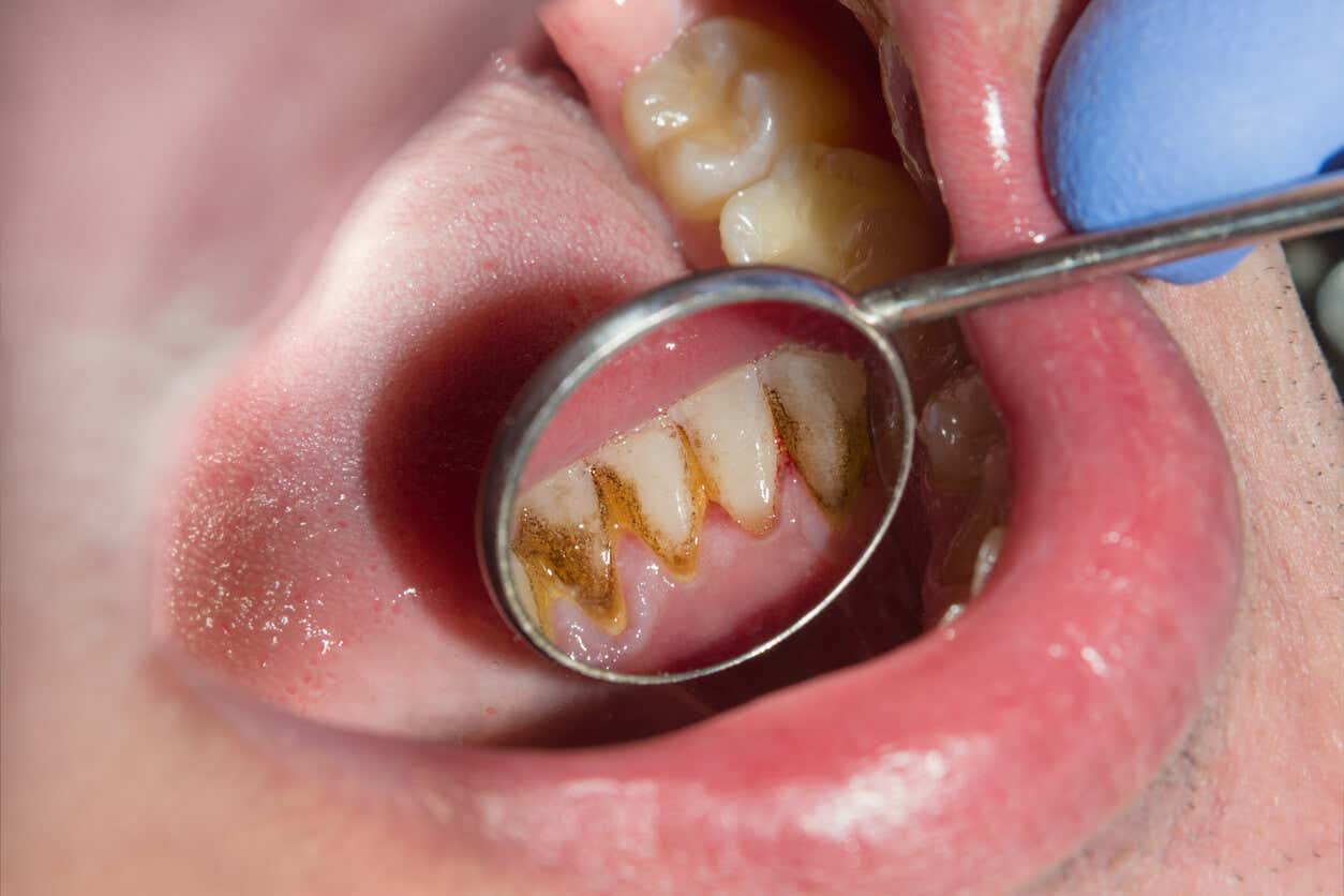¿Qué es y por qué se produce el sarro de los dientes?