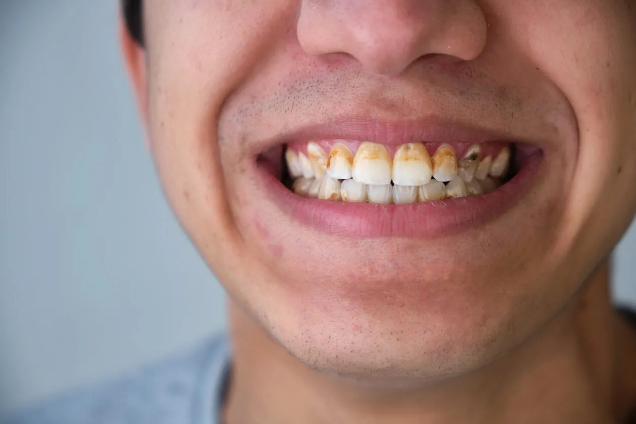 Sarro por placa bacteriana dental.