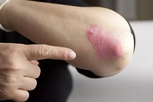 what is psoriasis: plaque psoriasis