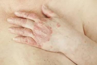 Mano con signos de psoriasis
