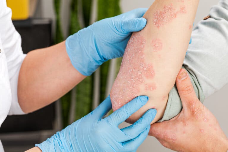 12 trucos y remedios naturales para aliviar la psoriasis