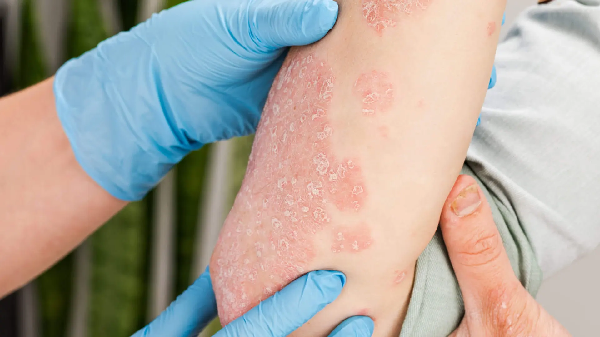 Psoriasis en codos.