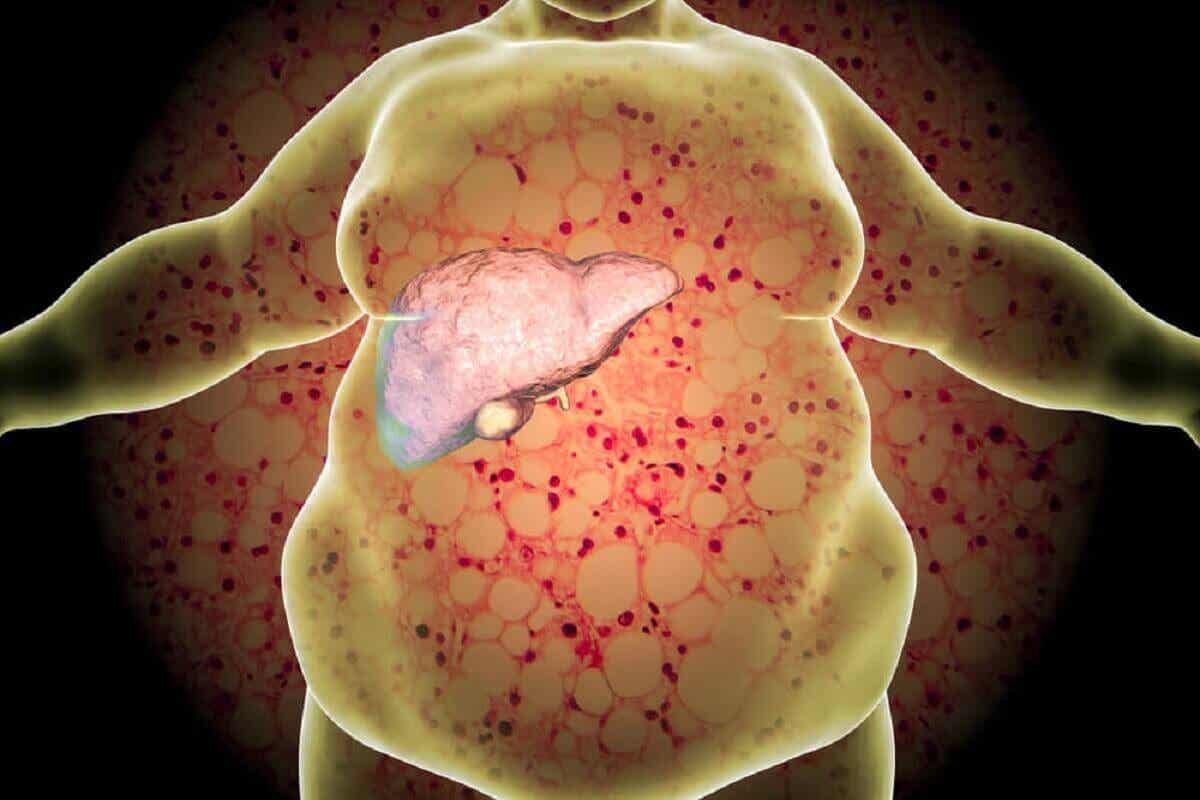 Obesidad es un factor de riesgo para hepatomegalia.