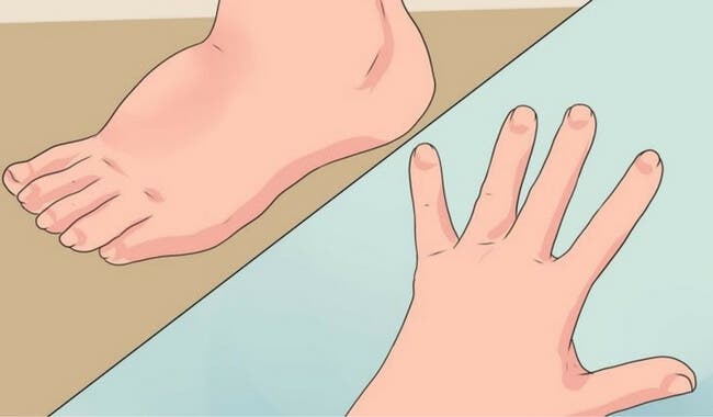 5 consejos para evitar la retención de líquidos