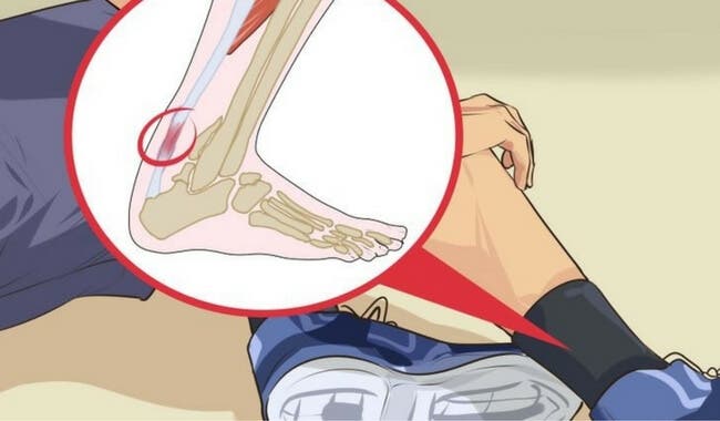 5 remedios contra la tendinitis en el talón de Aquiles