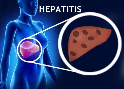 Hepatitis.