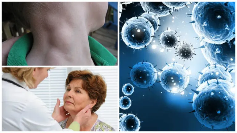 Linfoma, un tipo de cáncer que puede tratarse con éxito si se detecta a tiempo