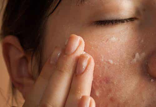 Prevenir el acné