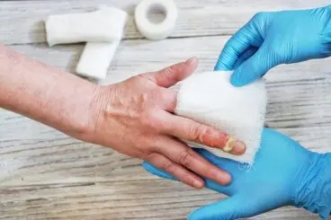 Primeros auxilios para quemaduras con agua caliente