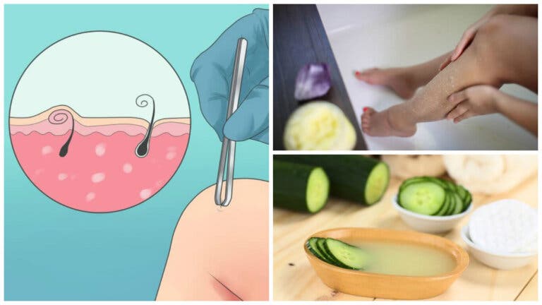 5 soluciones naturales para eliminar los pelos enquistados