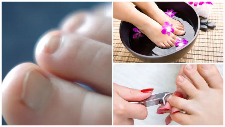 7 cosas sobre los hongos en las uñas que debes saber