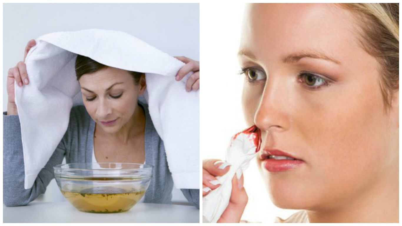 7 efectivas soluciones caseras para las hemorragias nasales
