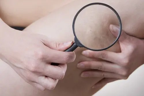 Celulitis